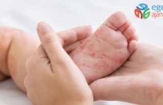Ailedeki alerjik reaksiyonlar çocuklara miras olabilir…